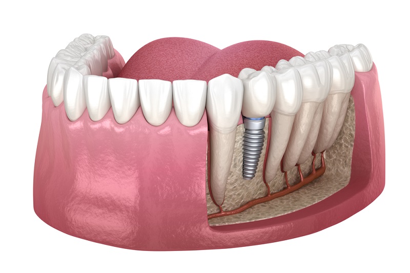 Exploring the Latest Advances and Innovations in Denture Implants