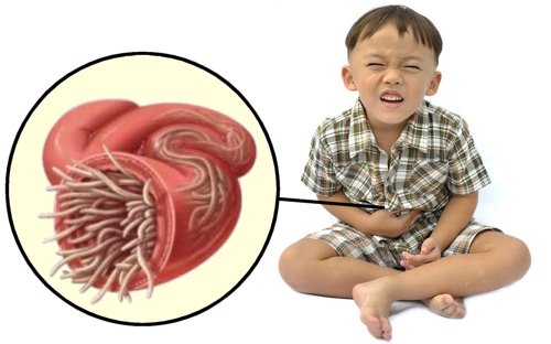 How to Treat a Common Childhood Intestinal Parasite Infection