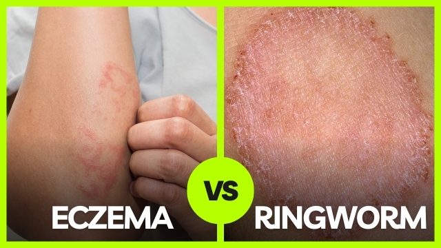 ringworm vs eczema