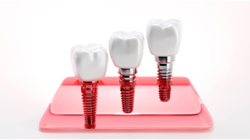 All-on-4 Implants Aberdeen: A Complete Guide to Full Arch Restoration