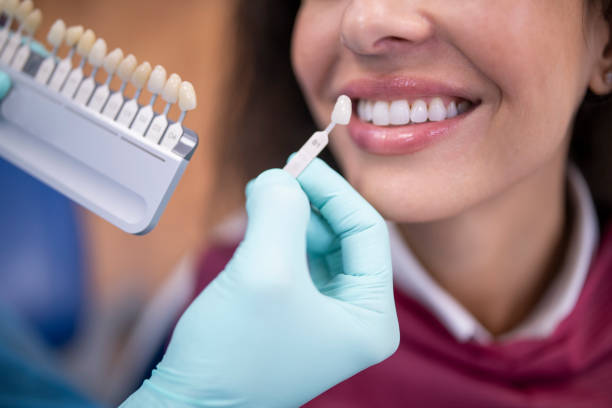 Treatments Teeth Whitening in Riyadh: Which One Is Right for You?