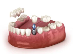 Dental Implant Aberdeen: A Comprehensive Guide to Tooth Replacement