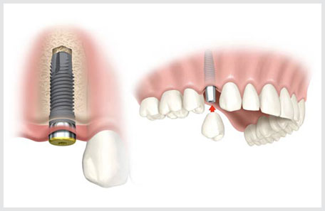 Single Implants Aberdeen: A Complete Guide to Tooth Replacement