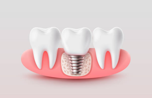 Smile Again: Revolutionary Dental Implant Solutions in Karachi